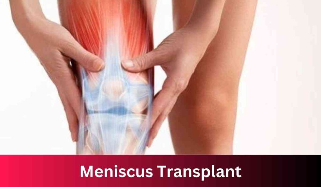 Meniscus Transplant